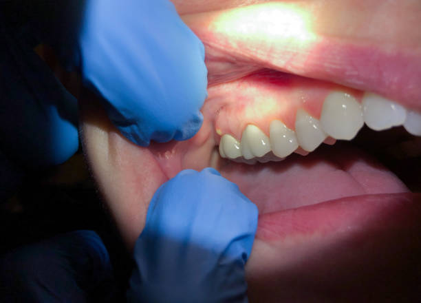 Best Knocked-Out Tooth (Avulsed Tooth) Treatment in Sayville, NY